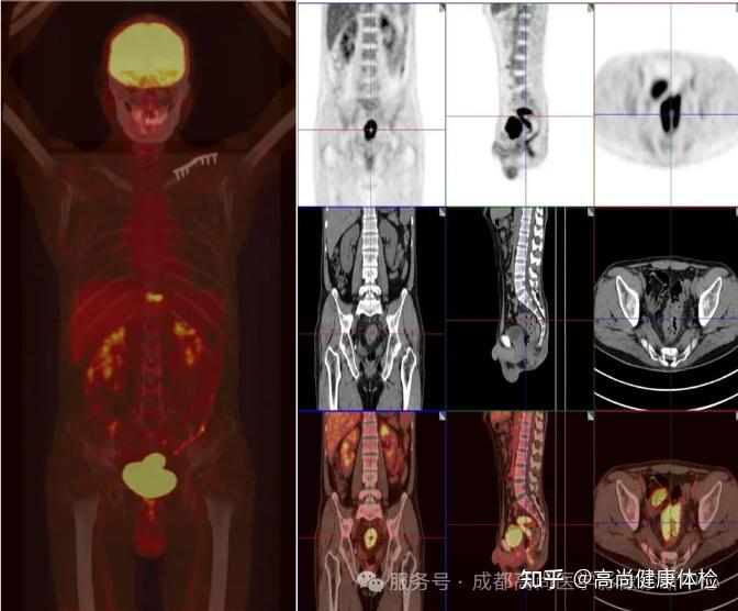 47岁男大便不成形发现直肠腺癌,18F-FDG PET/CT联合HR-MR评估全身情况 - 知乎