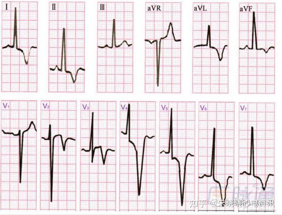 心尖肥厚型心肌病心电图改变