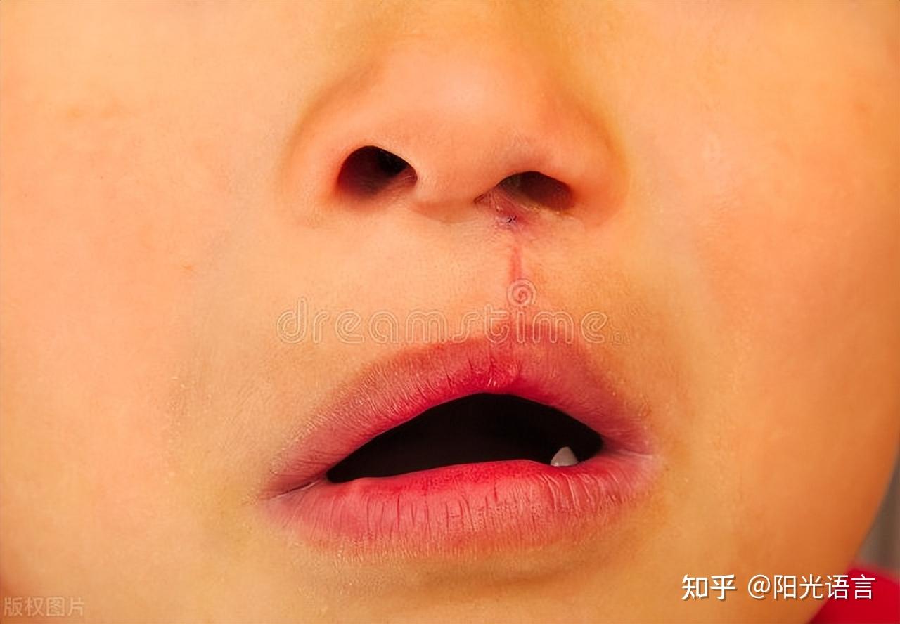 应用二维超声联合三维超声自由解剖成像技术诊断胎儿唇腭裂的体会