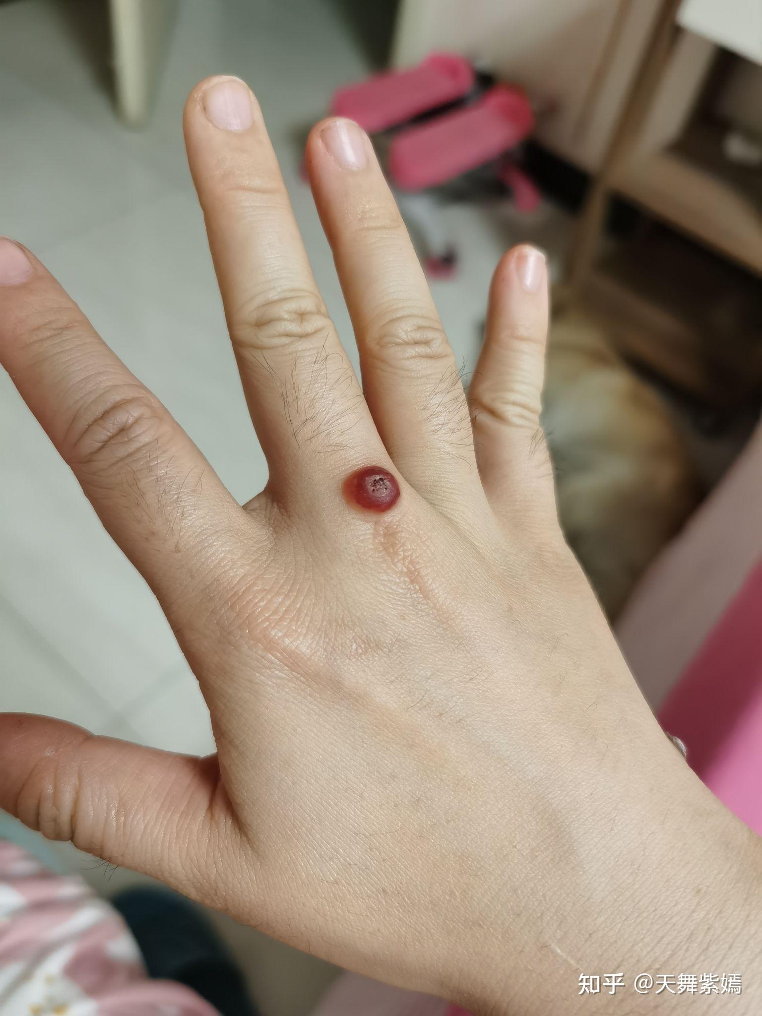 记录我的瘊子冷冻到脱落过程