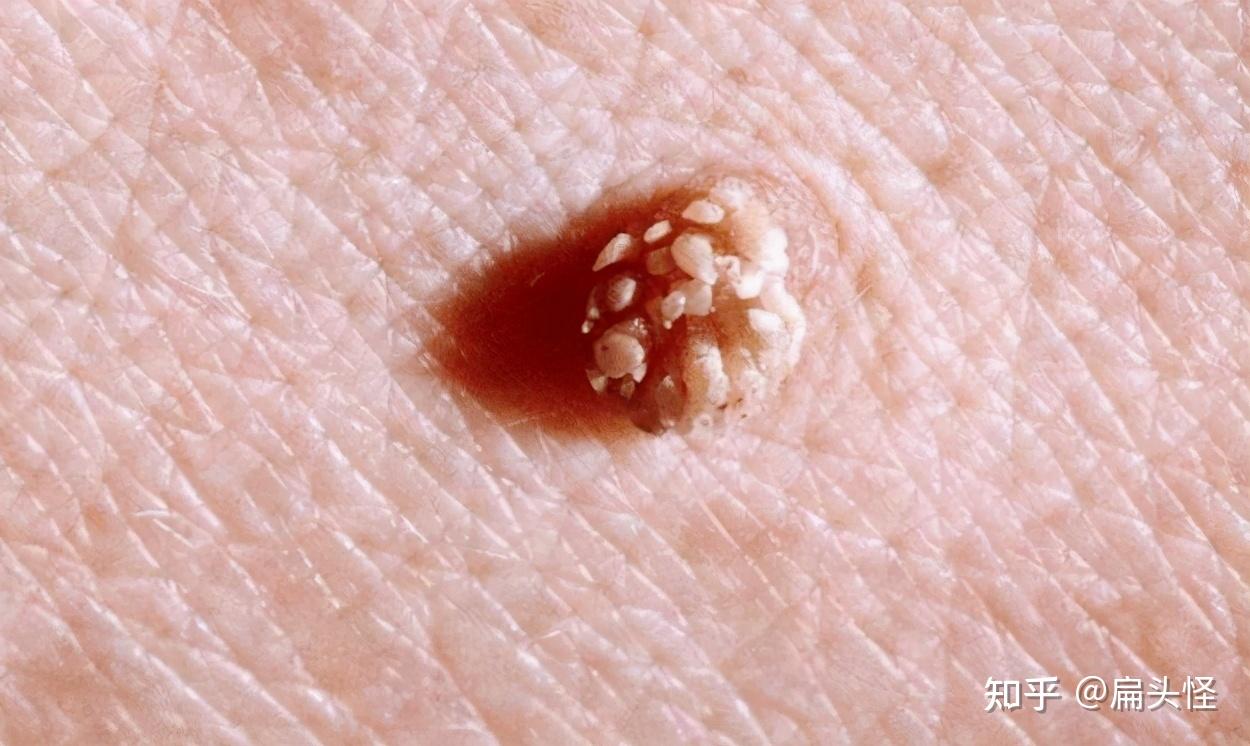 hpv病毒图片 zhuanlan.zhihu.com