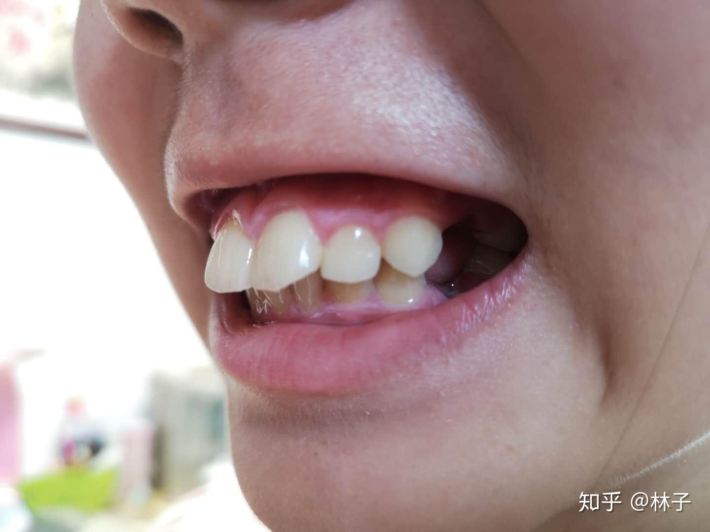 女儿12岁牙齿矫形实记