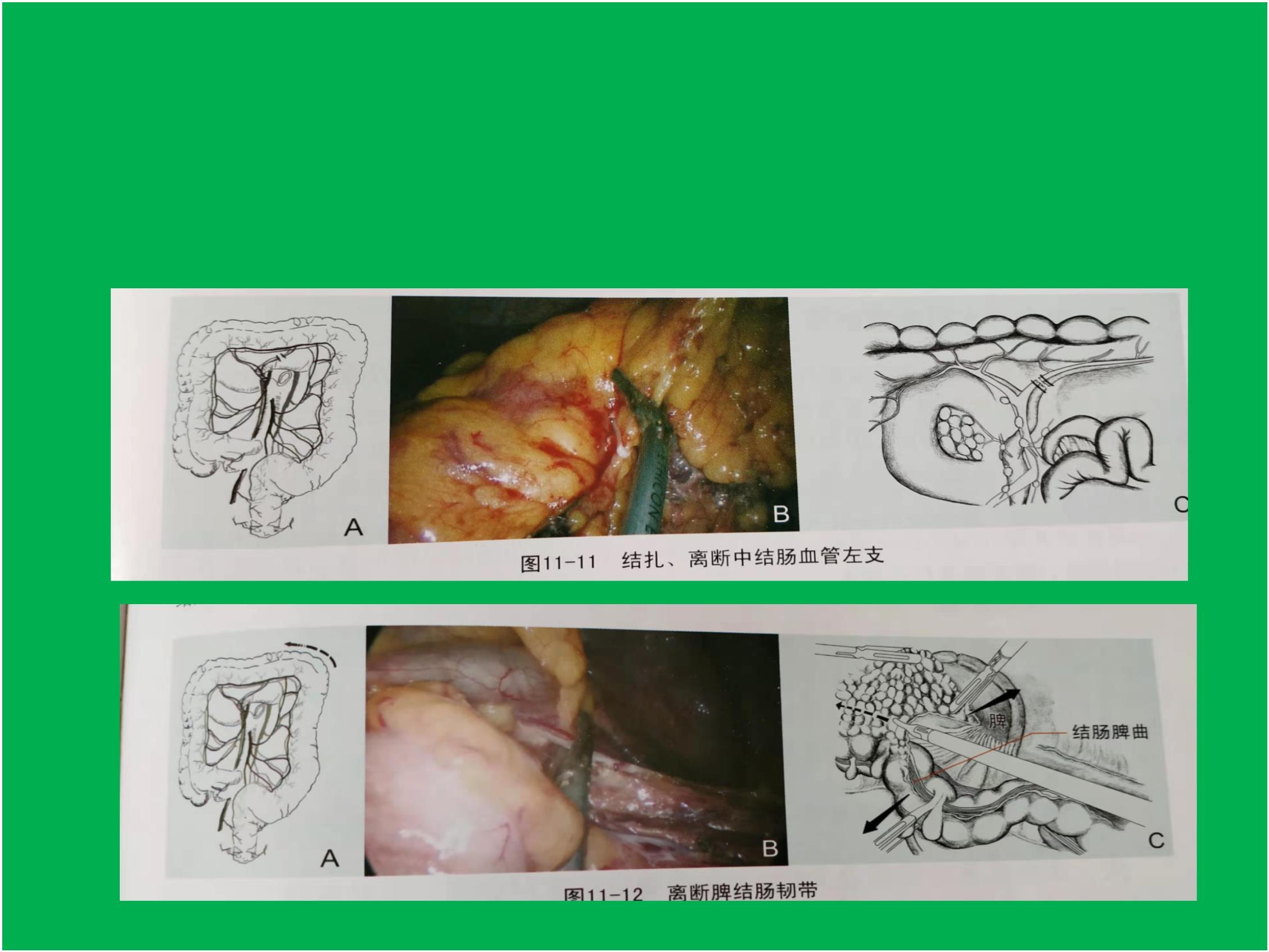 腹腔镜结肠癌根治术手术过程