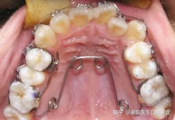 中家医家庭医生口腔牙齿矫正为什么要做扩弓