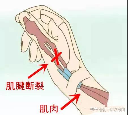 弯了→戴套→直了:手指肌腱断裂还可以这样自愈 - 知乎