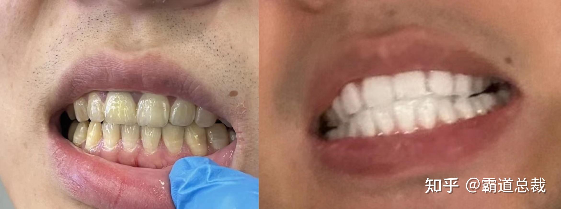 洁牙和龈下洁治有何区别？祛除牙结石应当如何选择