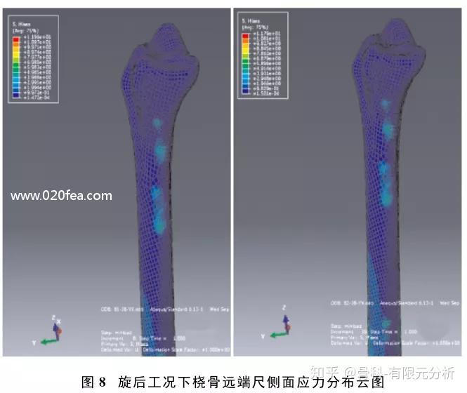尺骨茎突骨折有限元模型的建立与力学分析 - 知乎