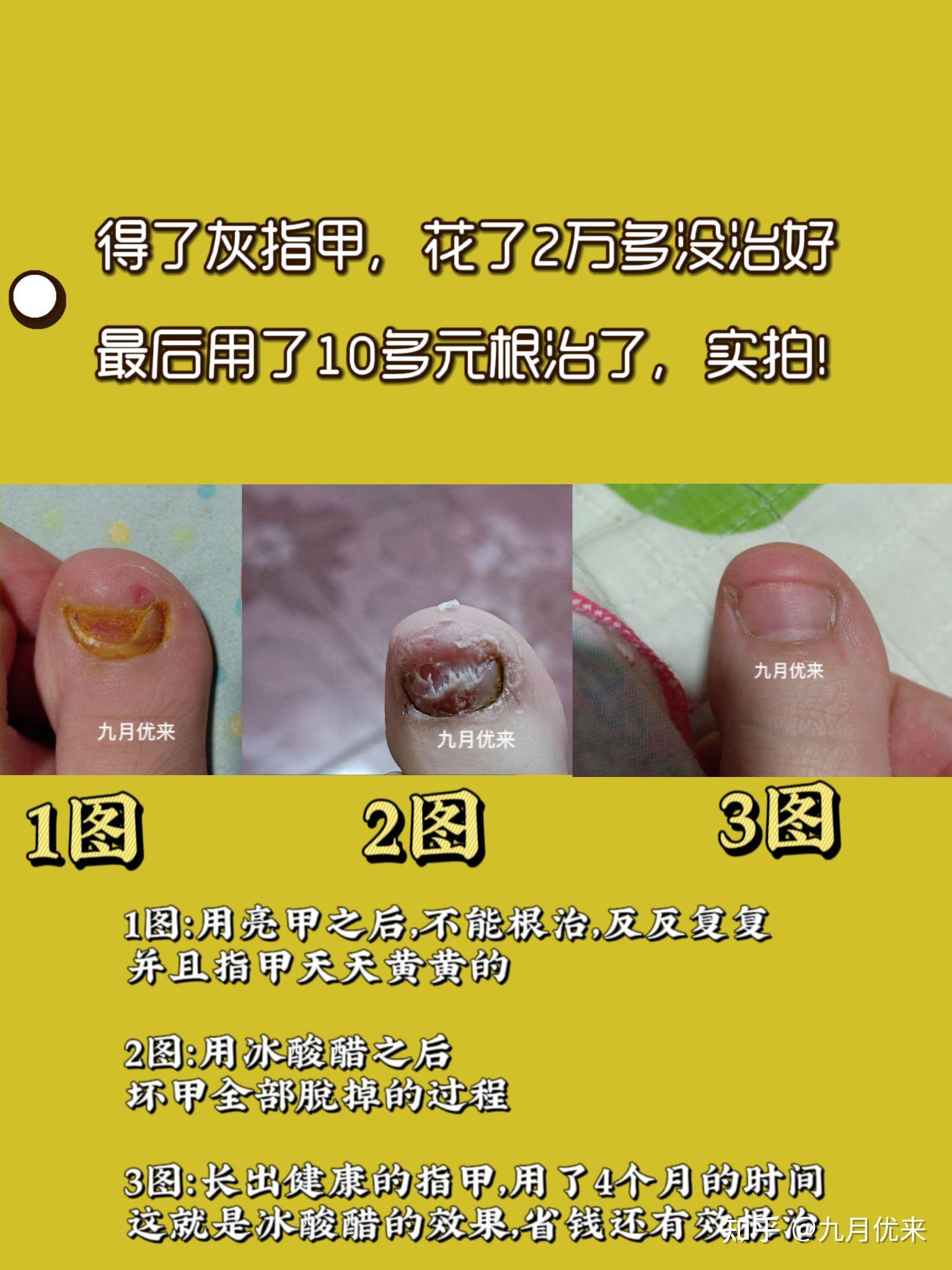我用30的冰酸醋封包根治了6年的灰指甲真实案例