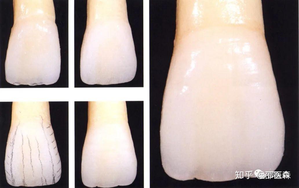 牙齿发育沟图片是什么图片
