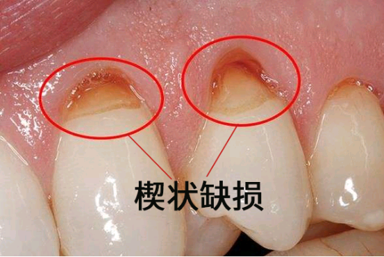如果长时间的横向刷牙会造成牙颈部严重磨损,形成牙齿楔状缺损