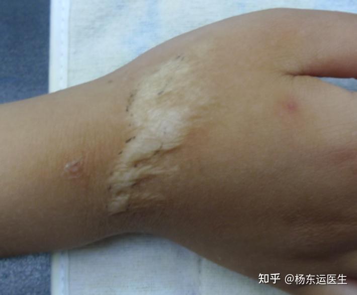 疤痕色脱是如何造成的