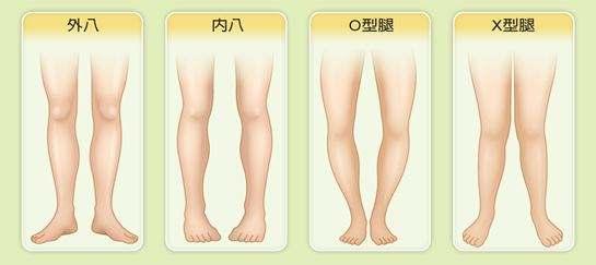 o型腿:膝内翻和膝外翻