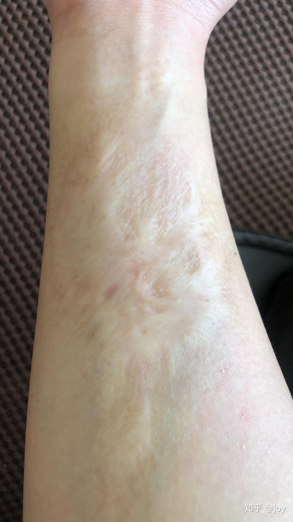 二十年的老疤痕治疗方式可以用植皮吗