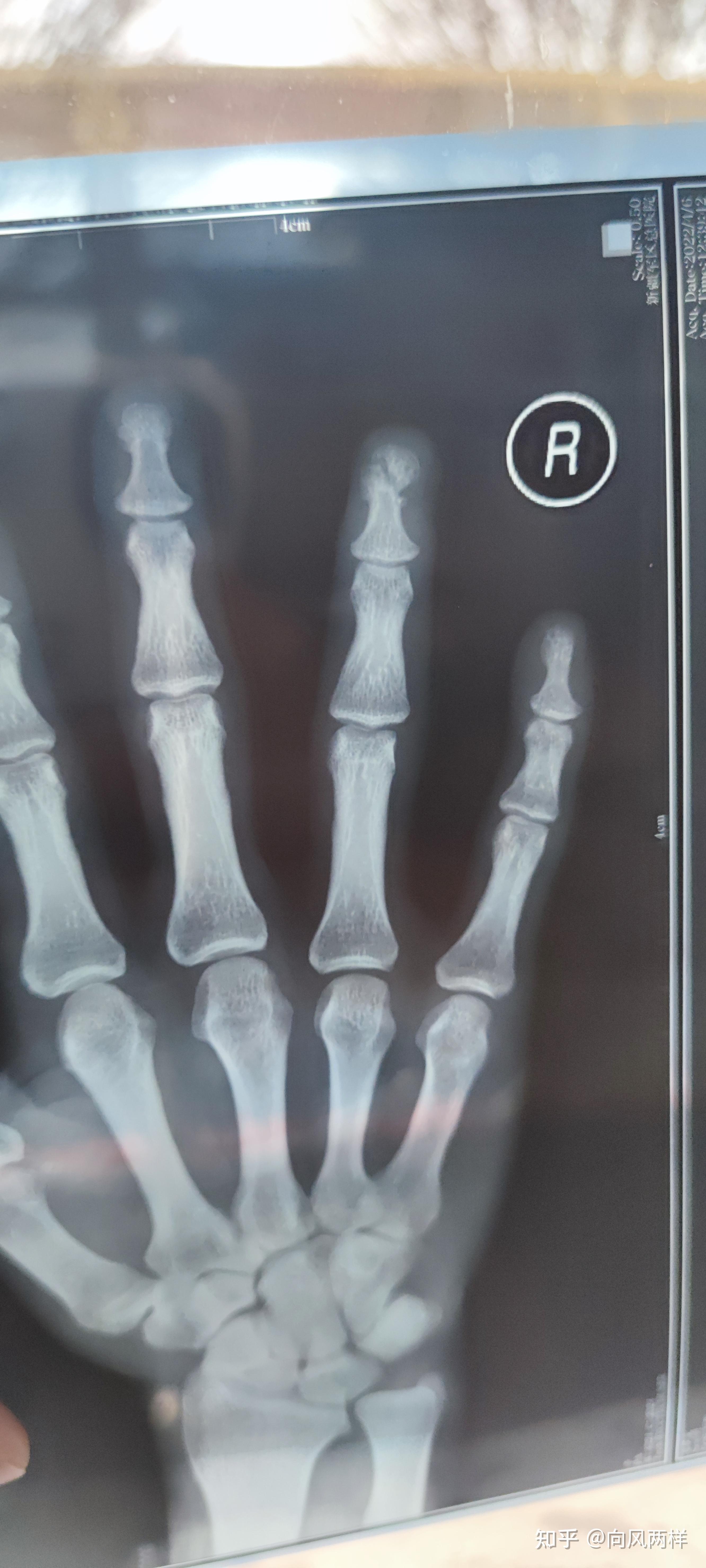4指被切断 医生用0.1毫米线缝合血管 历时10小时完成断指再植_手指