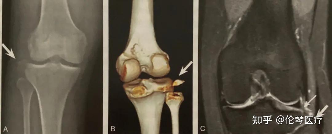 mri 矢狀位 pdwi spair顯示股骨外側髁和脛骨平臺後份關節面下骨挫傷