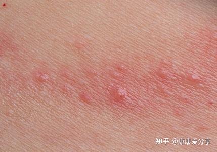 身上起红疙瘩越挠越痒可能是这9种皮肤病
