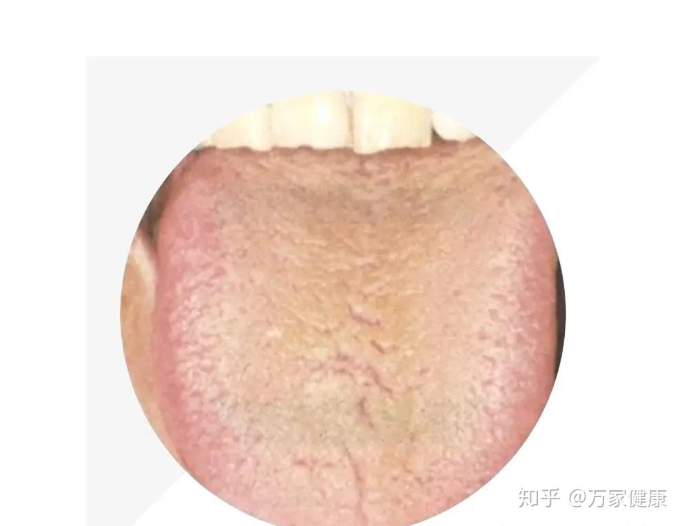 觀察舌苔自己是否健康