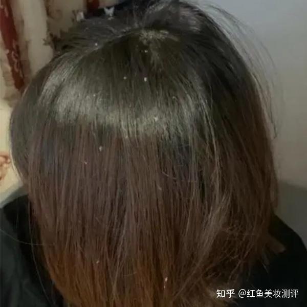 头皮干痒头皮屑是何原因??持久去屑保湿滋润 - 知乎