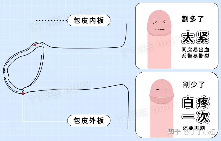 抖音小伙网购器械自己割包皮丁丁从5方面论证行不行