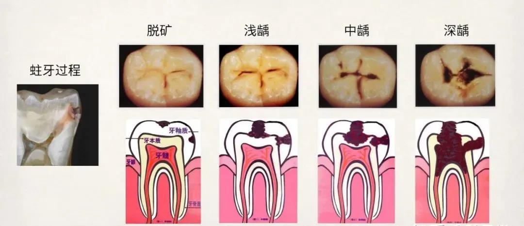 補牙 唄 ▼ 但是你知道嗎 有些蛀牙是補不了的 等牙齒蛀到 第③階段