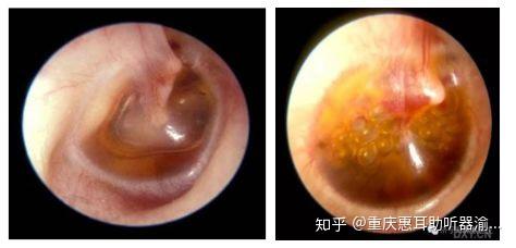 耳朵鼓室积液图片