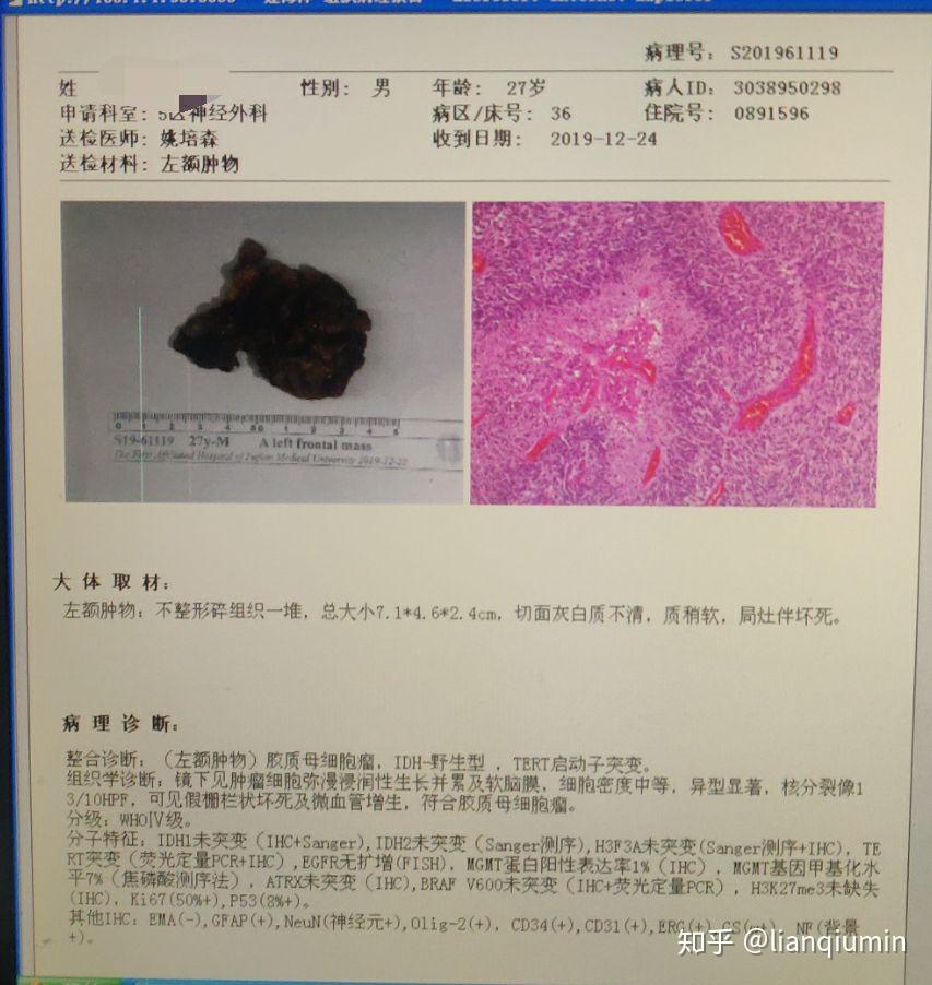 胶质母细胞瘤胶母whoiv程序猿的下半生该何去何从