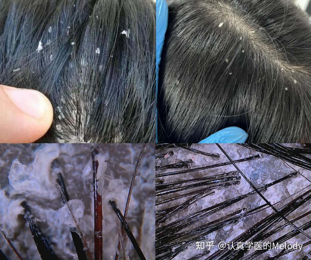 【精准去屑】头皮屑太多了怎么办?头皮屑疯长、大块还有救吗?皮肤科医生教你1招最全去屑方法!【油螨菌】通通去除,28天轻松解决”雪花头“! - 知乎