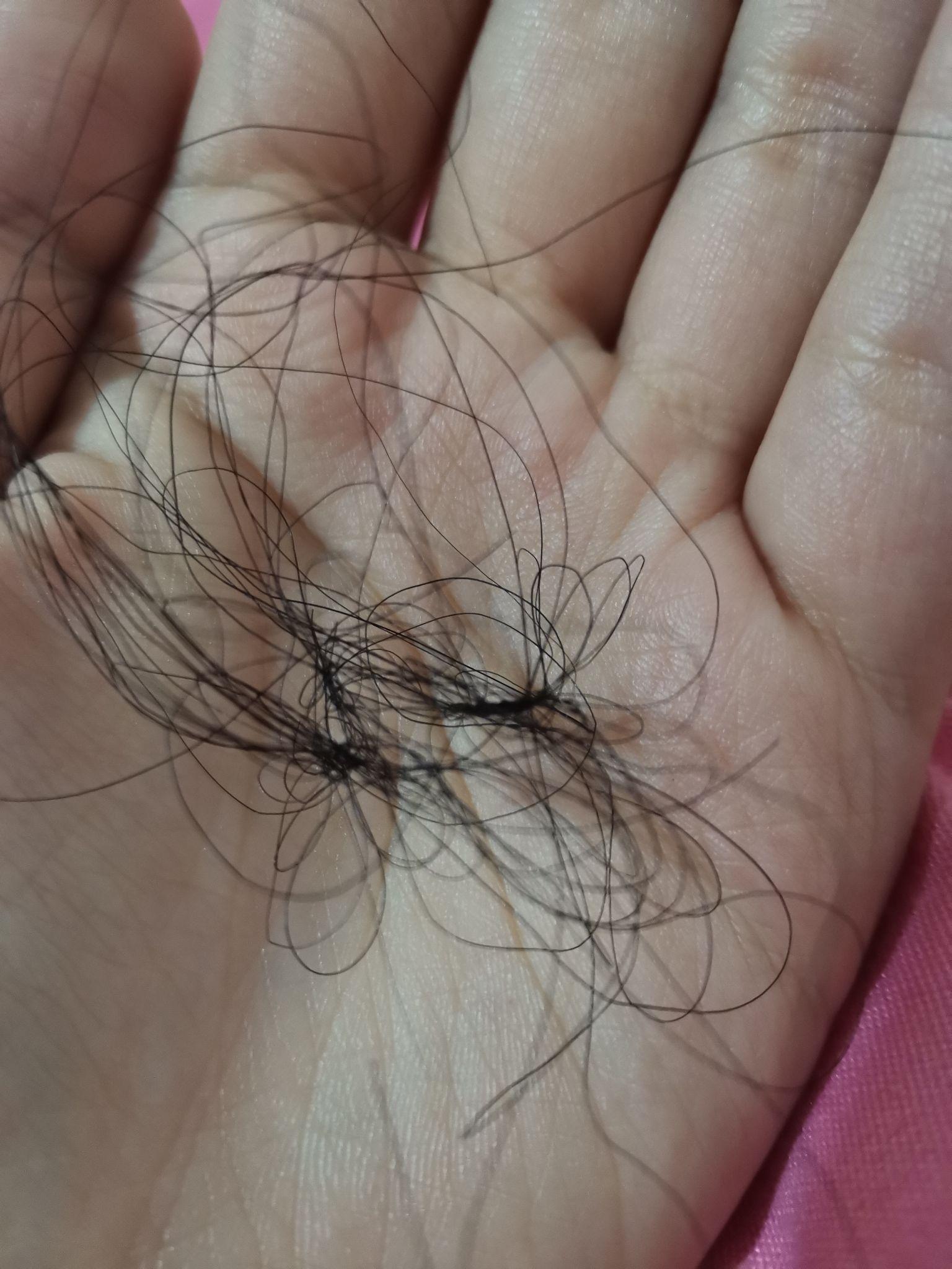 记录一下脂溢性脱发女生用米诺地尔的过程 