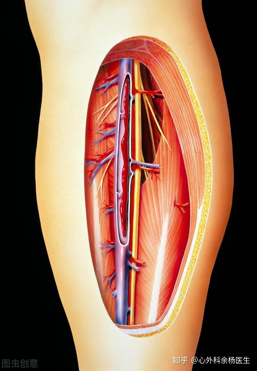 下肢静脉血栓滤器图片