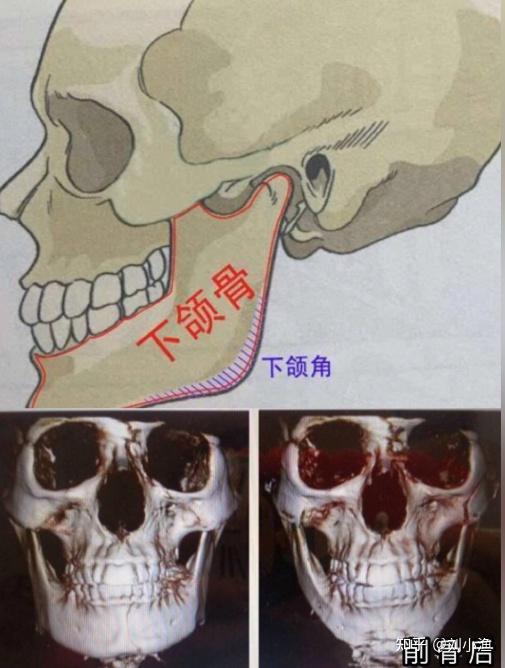 讓線條不那麼直,硬磨骨—是用器械對你的骨頭進行打磨,磨成骨碎讓骨頭