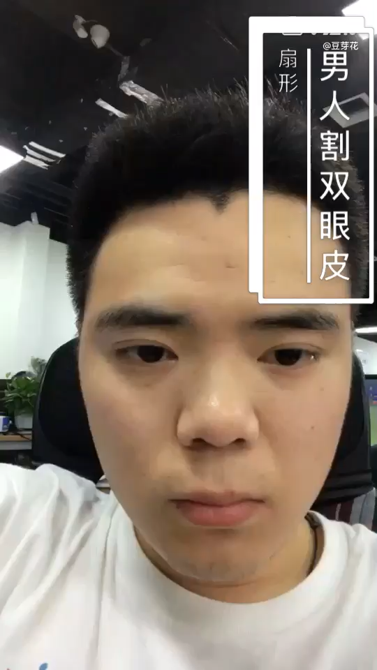 男人割雙眼皮好嗎?