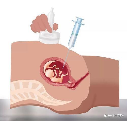 通过羊膜腔穿刺术(羊穿)或绒毛穿刺术或脐带血穿刺术,获取胎儿细胞