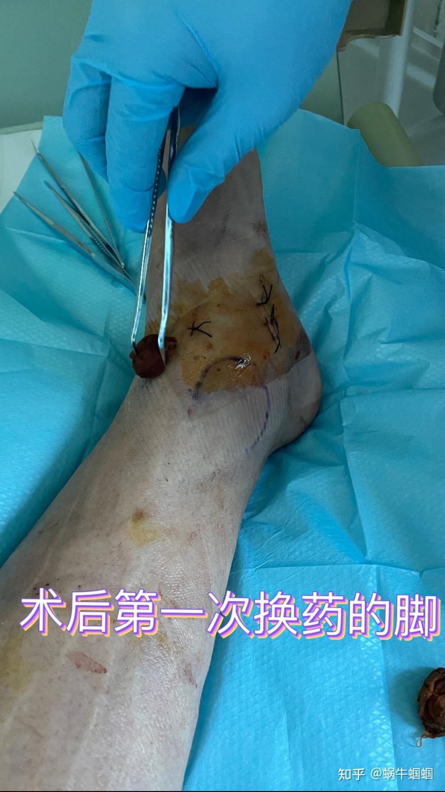 一名副舟骨患者的分享