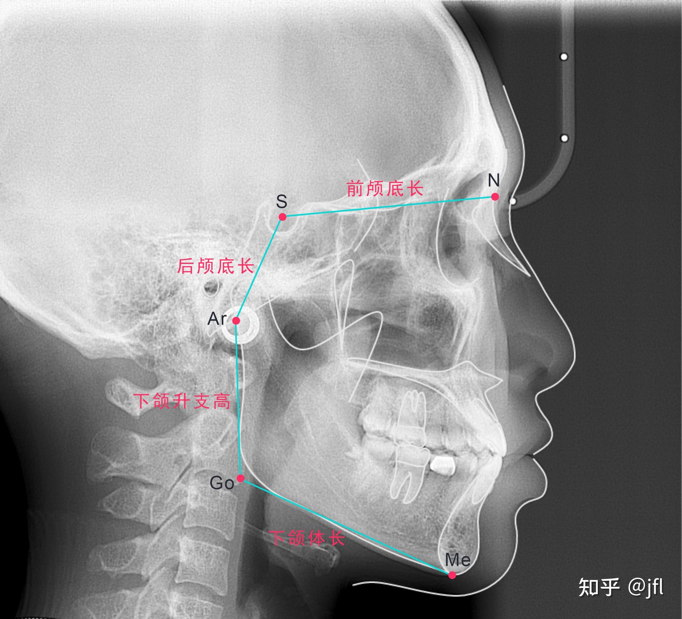 其中,go为重建下颌角点,下颌下缘和后缘切线的交点.