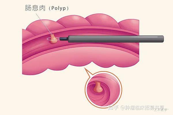 我叫息肉很容易變成癌