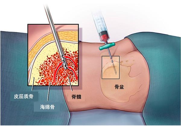 穿刺活检会引起癌症扩散或转移吗