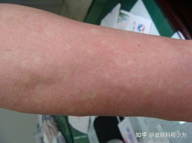 马歇尔怀特综合症医生解答:马歇尔怀特综合症是由内脏自主神经功能