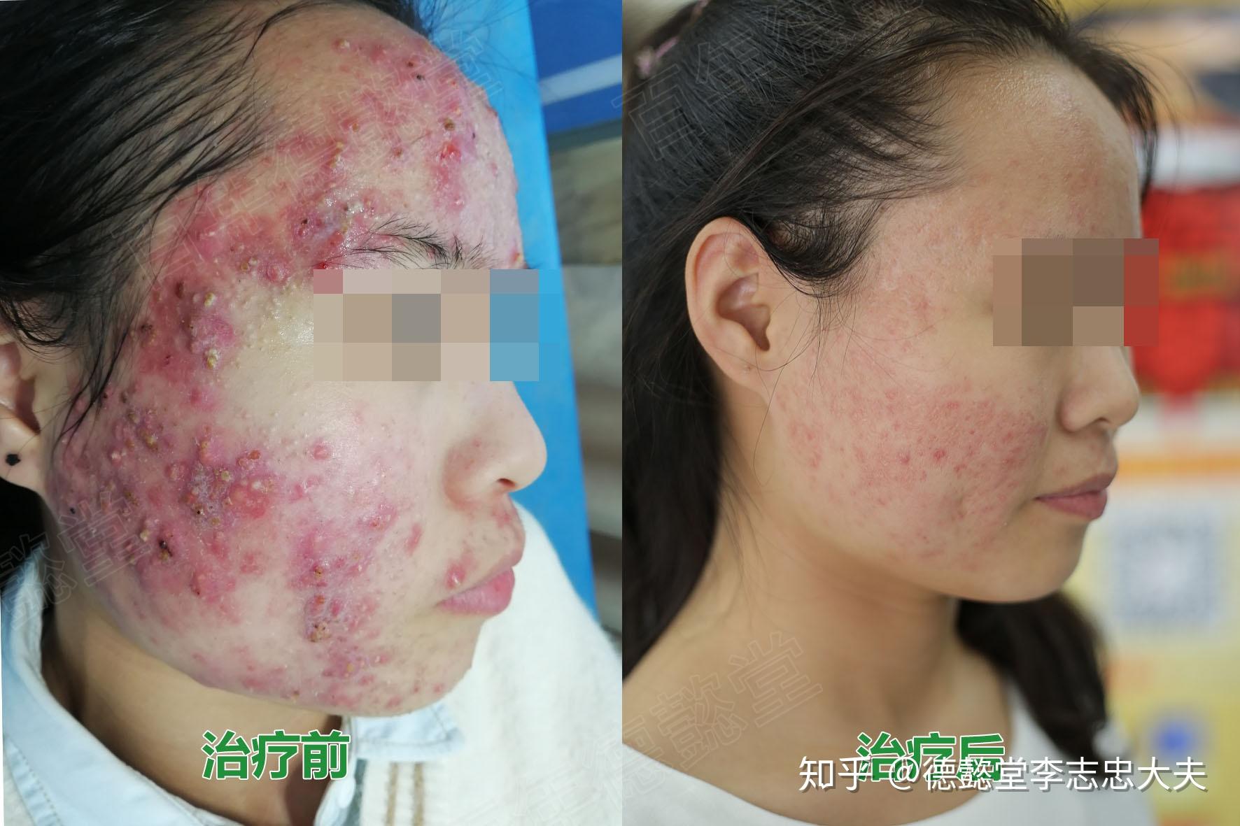 严重性痤疮青春痘治疗案例