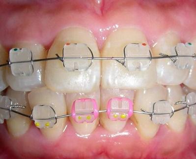 图源网络侵删陶瓷自锁牙套陶瓷托槽直接带有锁扣,按下锁扣钢丝和托槽
