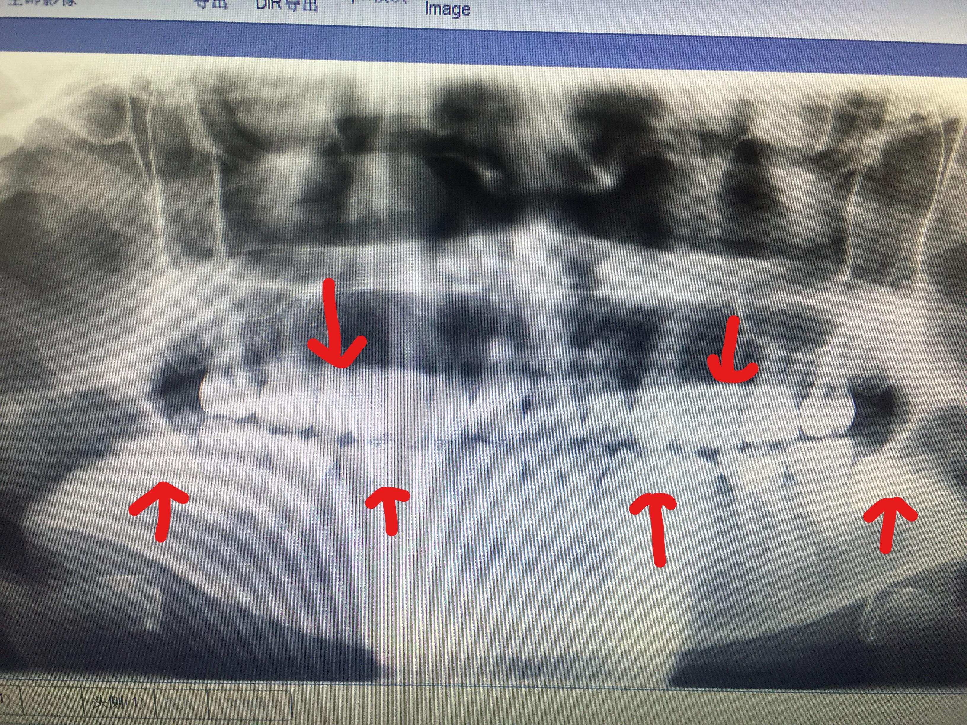 下面是牙齿x光的照片:在开始正畸之前,做了很长时间的功课,基本上知乎
