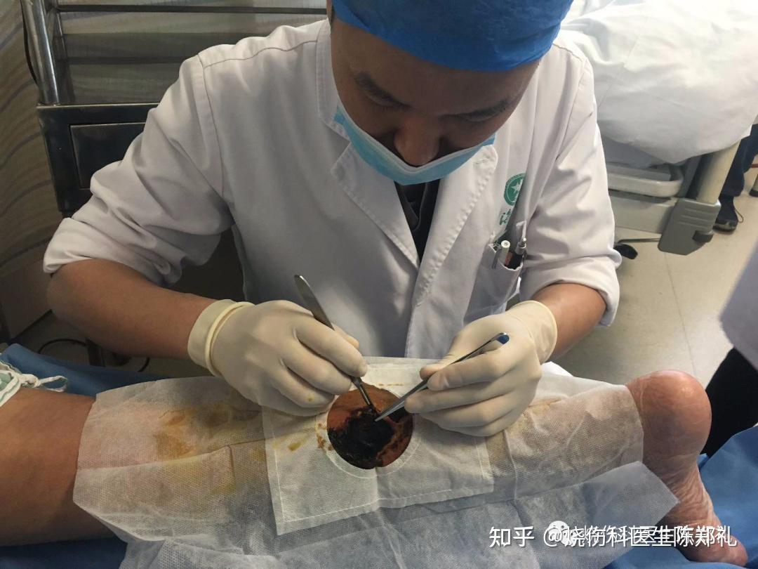 清创术的具体流程及注意事项 -- 术中篇