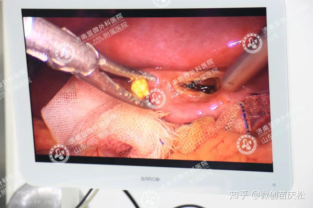 铲除胆囊结石胆总管结石双镜联合是如何做到的
