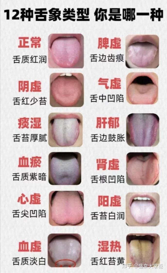如何判断自己是否生病了?每天花3秒钟看一眼舌头,你身体自带的“体检报告”,大病小病早知道! - 知乎