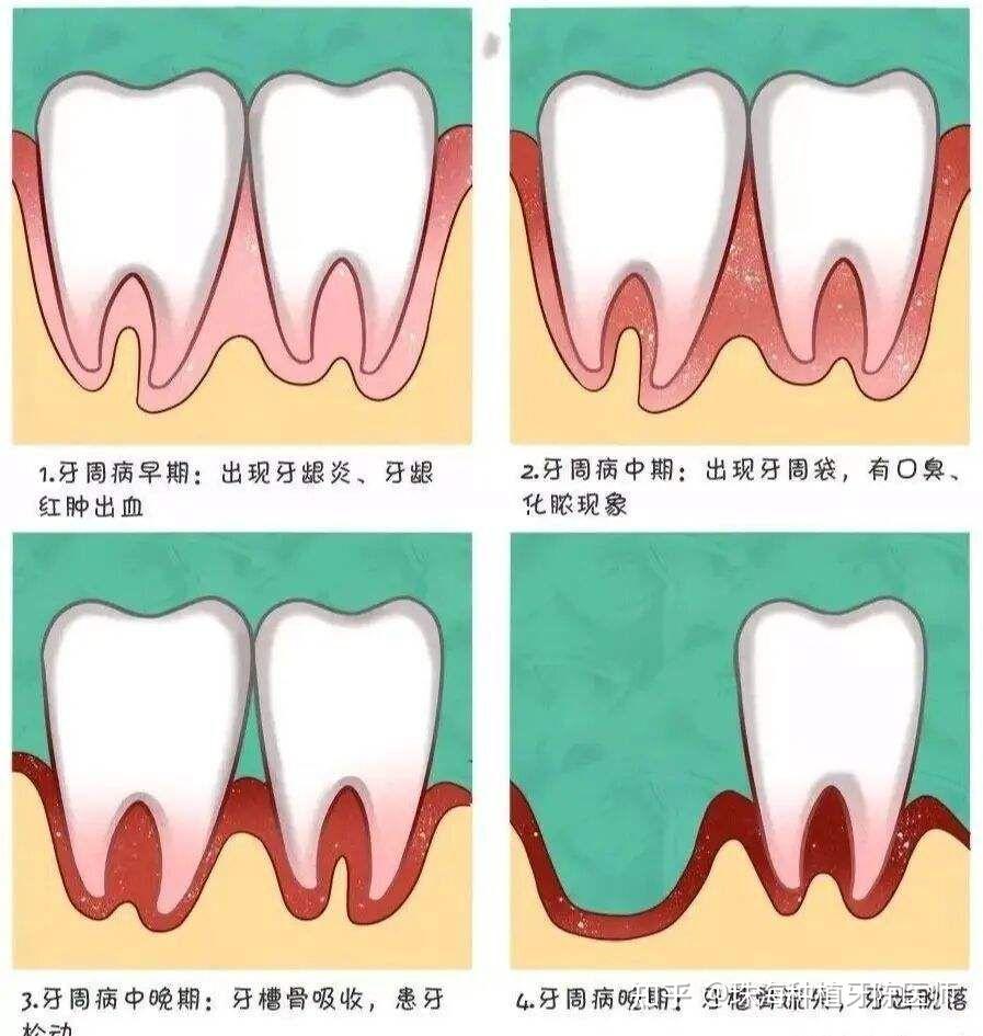 牙龈炎:牙龈炎主要是由牙菌斑引发的牙龈组织的炎症.