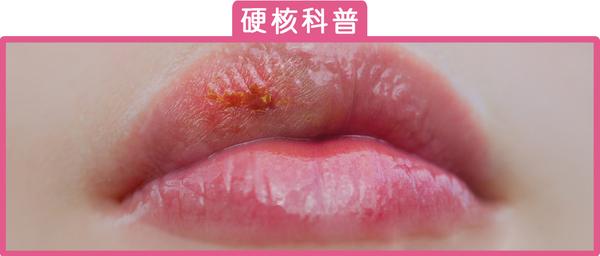 166吃瓜网友科普：嘴上起泡是什么原因及解决方法