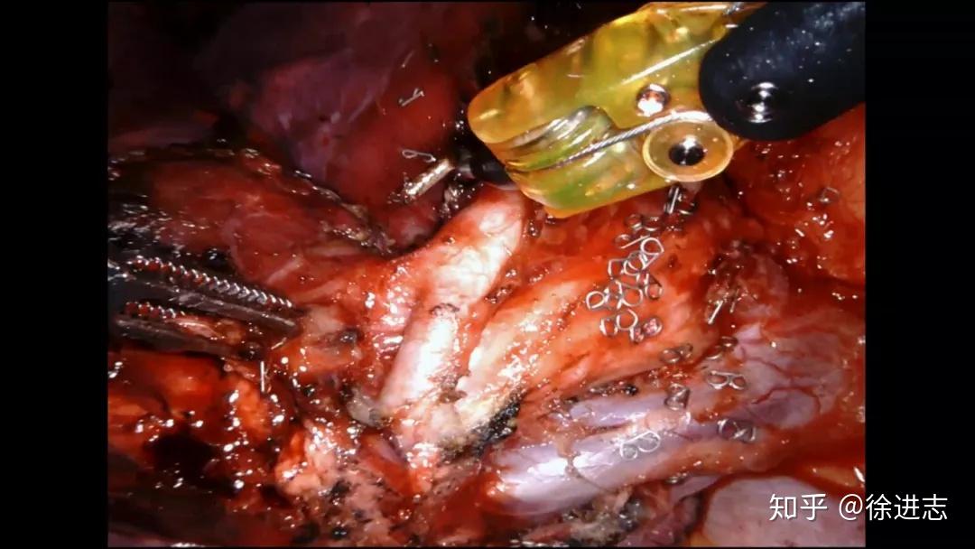 机器人辅助使哈医大四院治疗肺磨玻璃结节彻底进入"段时代"