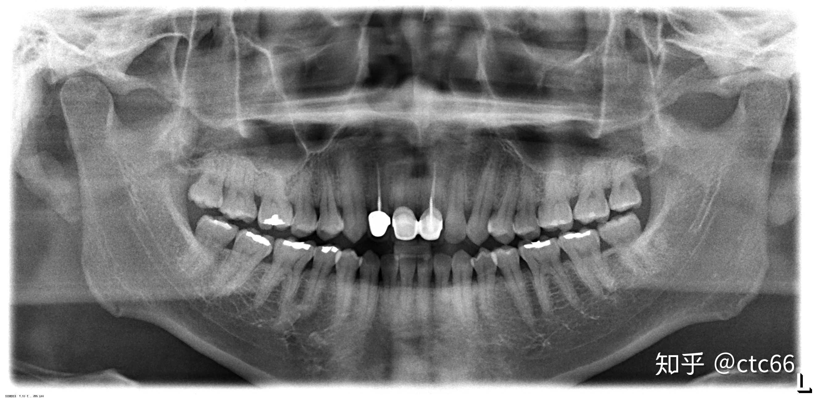 前面几个案例都是智齿垂直但仍然长不出来的智齿,那有没有智齿很直挺