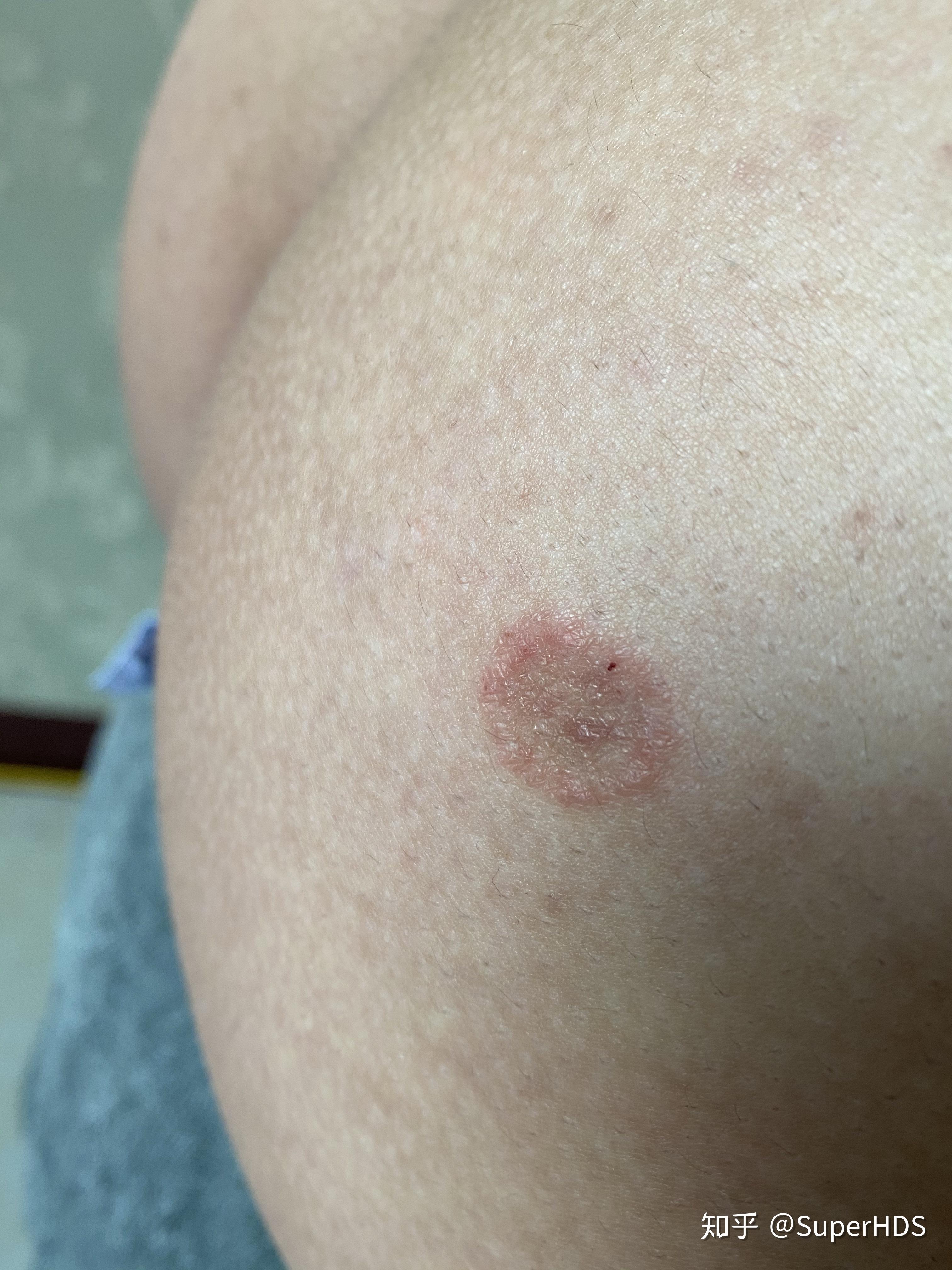 这是股藓吗之前痒抠烂了之后变成这样了