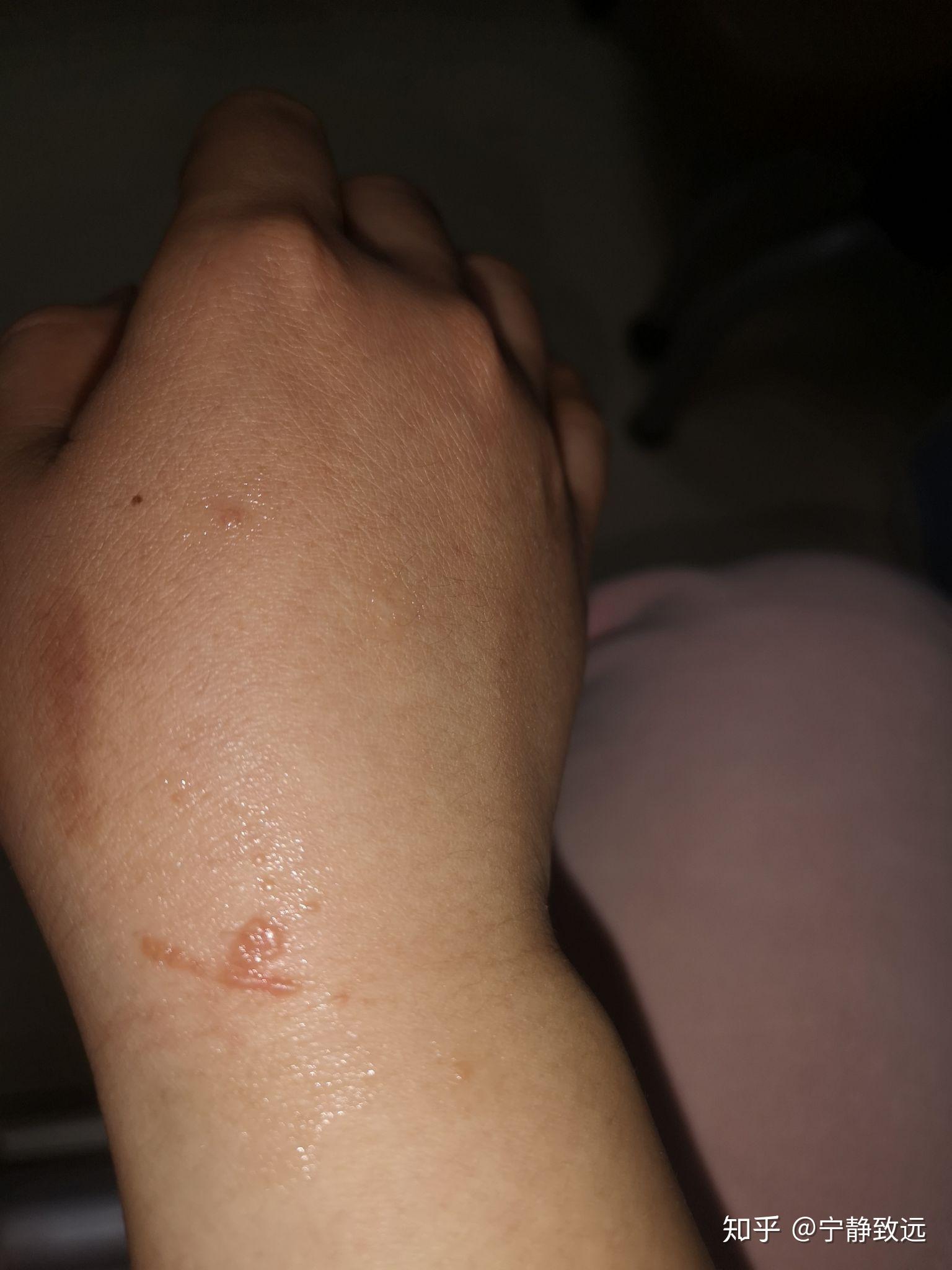 我的扁平疣治好了