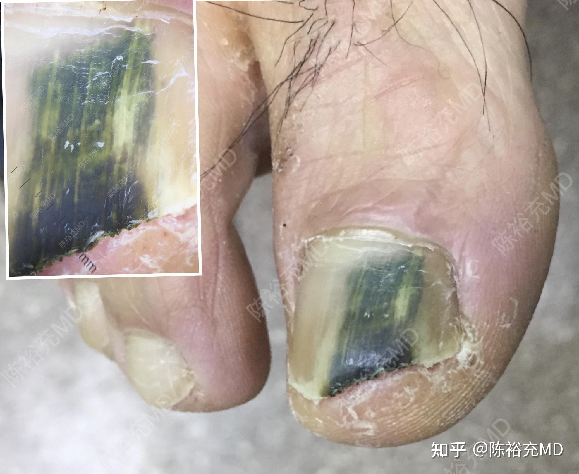 指甲趾甲黑斑是黑色素瘤吗